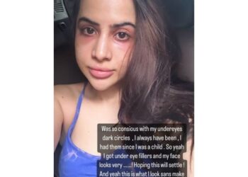 Urfi Javed did beauty treatment to avoid trolls, the place of recovery and ruined face