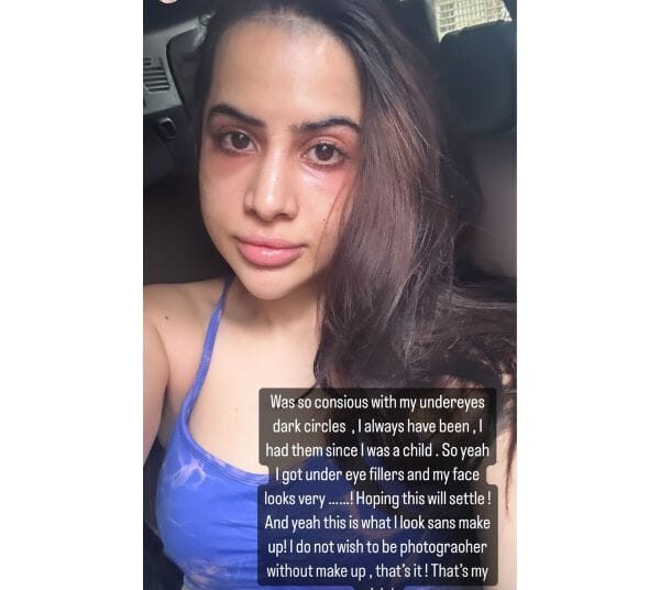 Urfi Javed did beauty treatment to avoid trolls, the place of recovery and ruined face